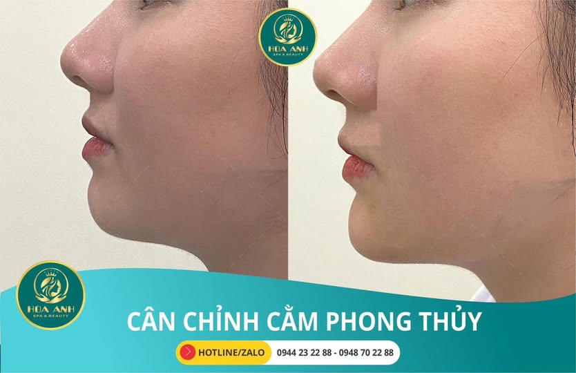 Trước và sau tiêm Filler cằm góc nghiêng tại Hoa Anh